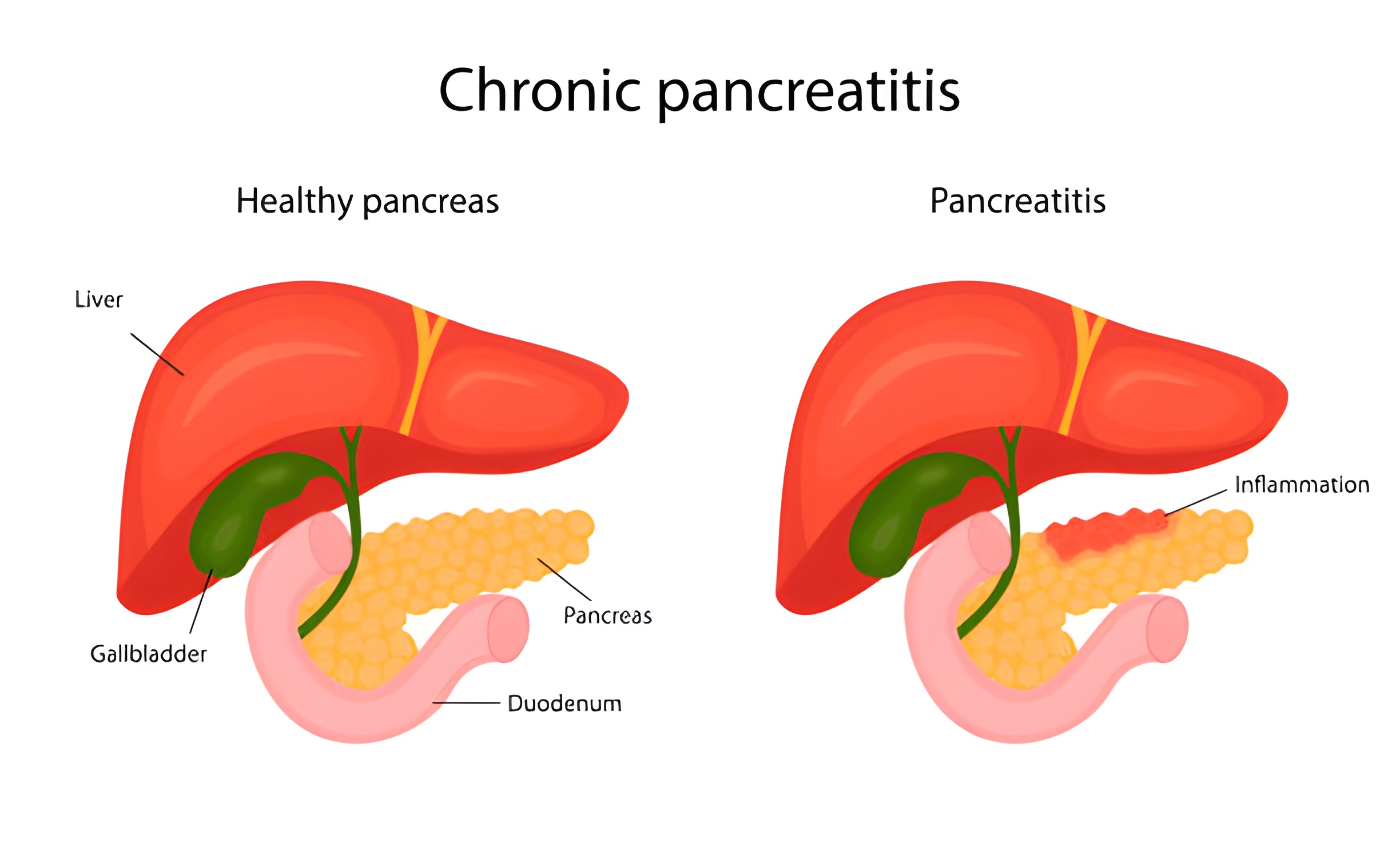  Каковы симптомы хронического панкреатита?