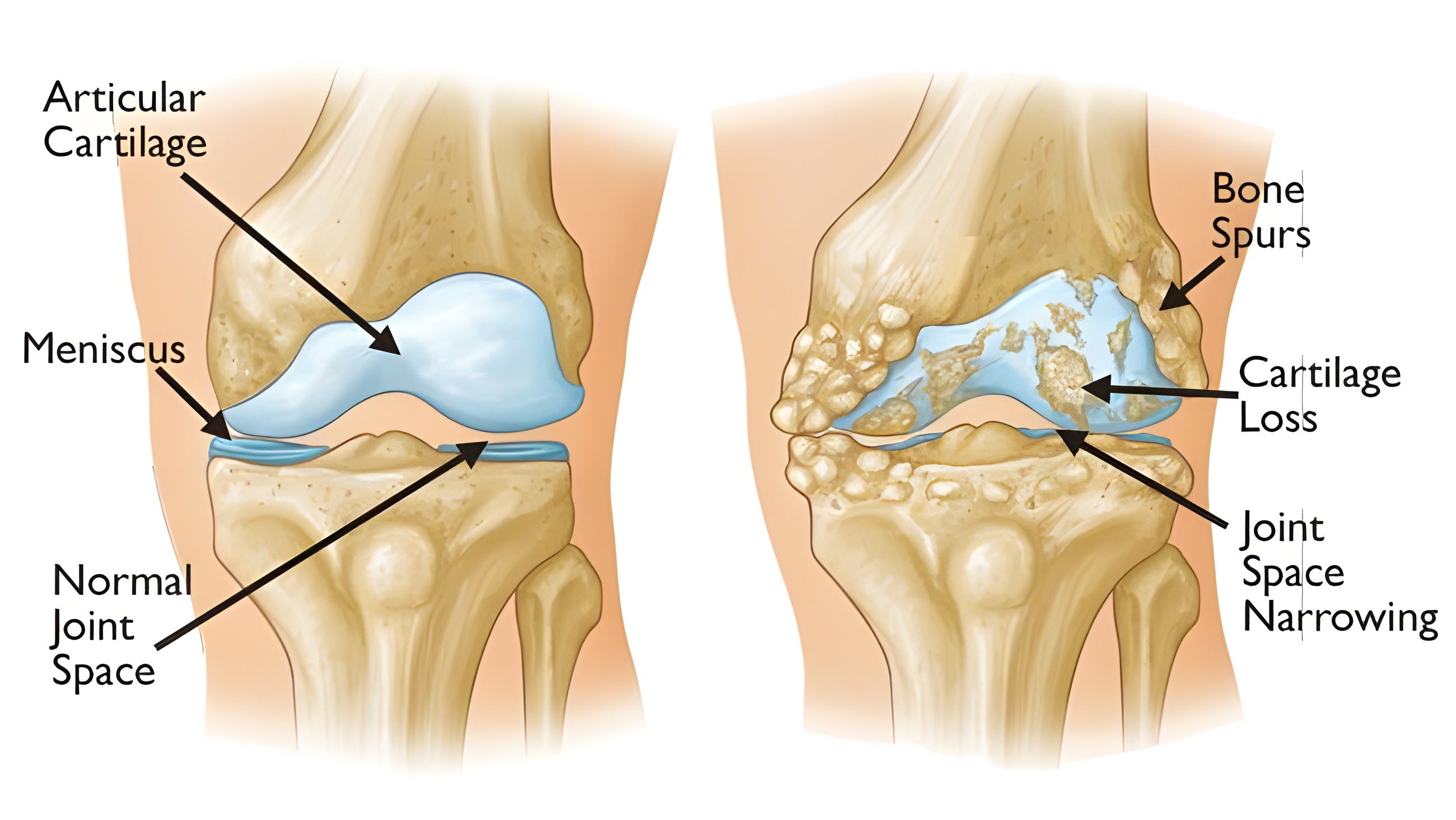 Схематическое изображение больного и здорового коленного сустава