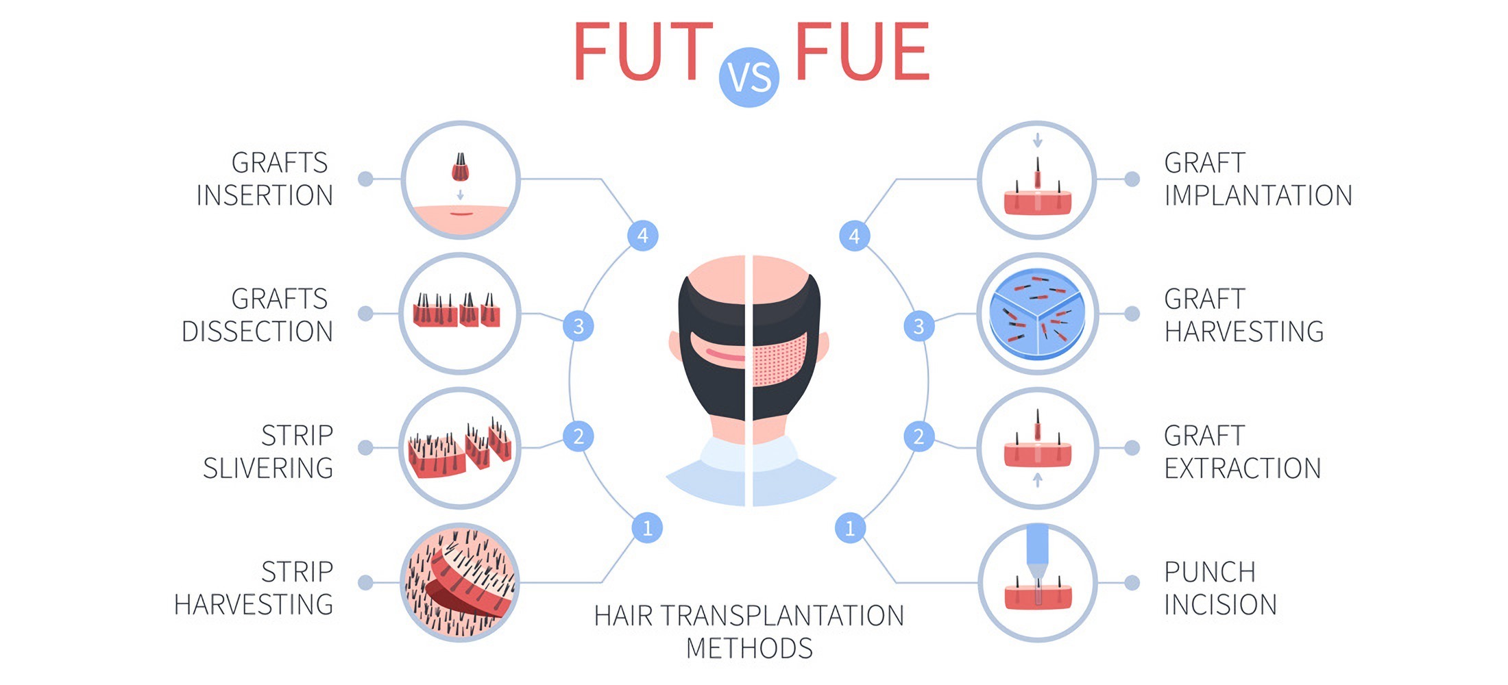 Методы трансплантации волос