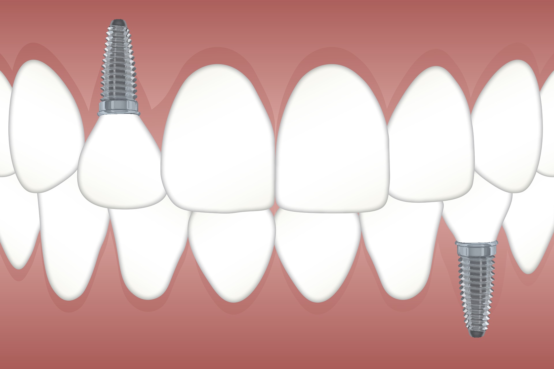 schematic representation of a dental implant