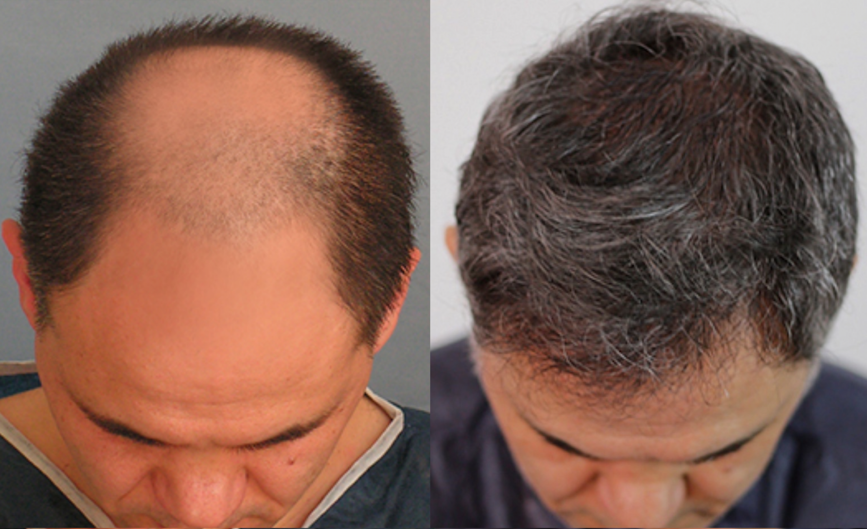 Трансплантация волос мужчине на лбу