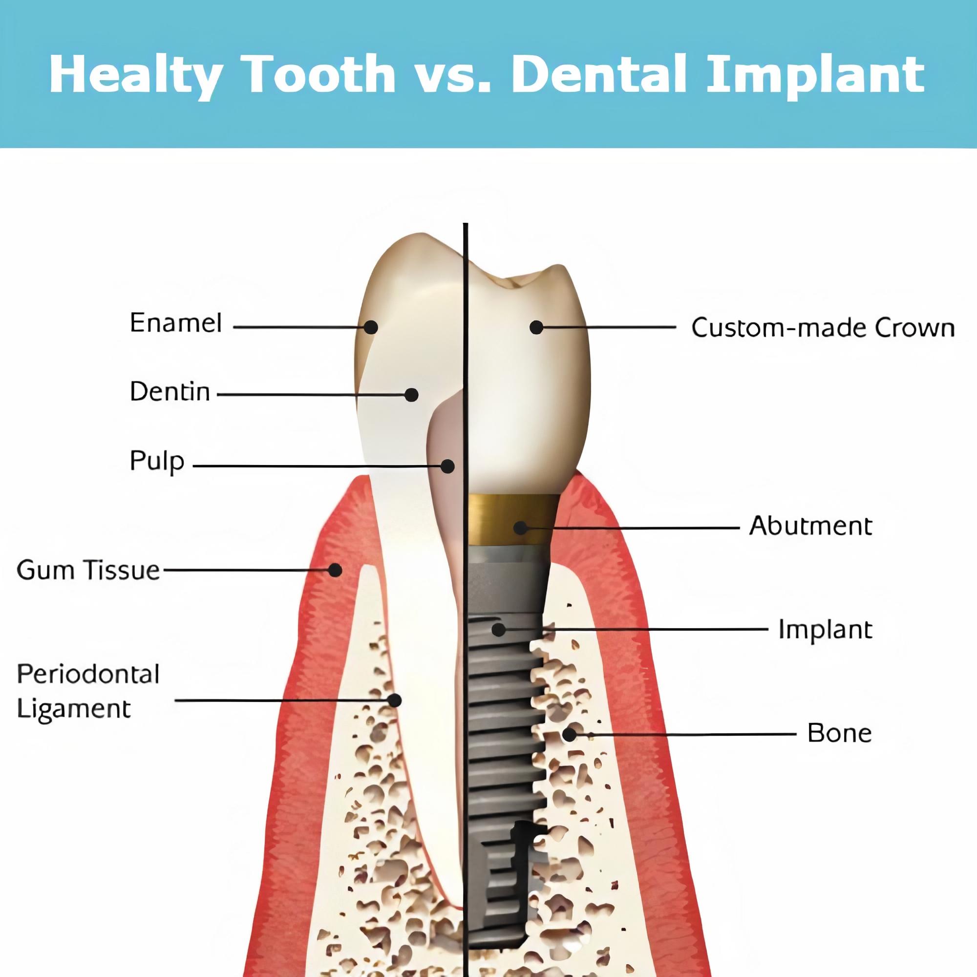 здоровые зубы против имплантатов