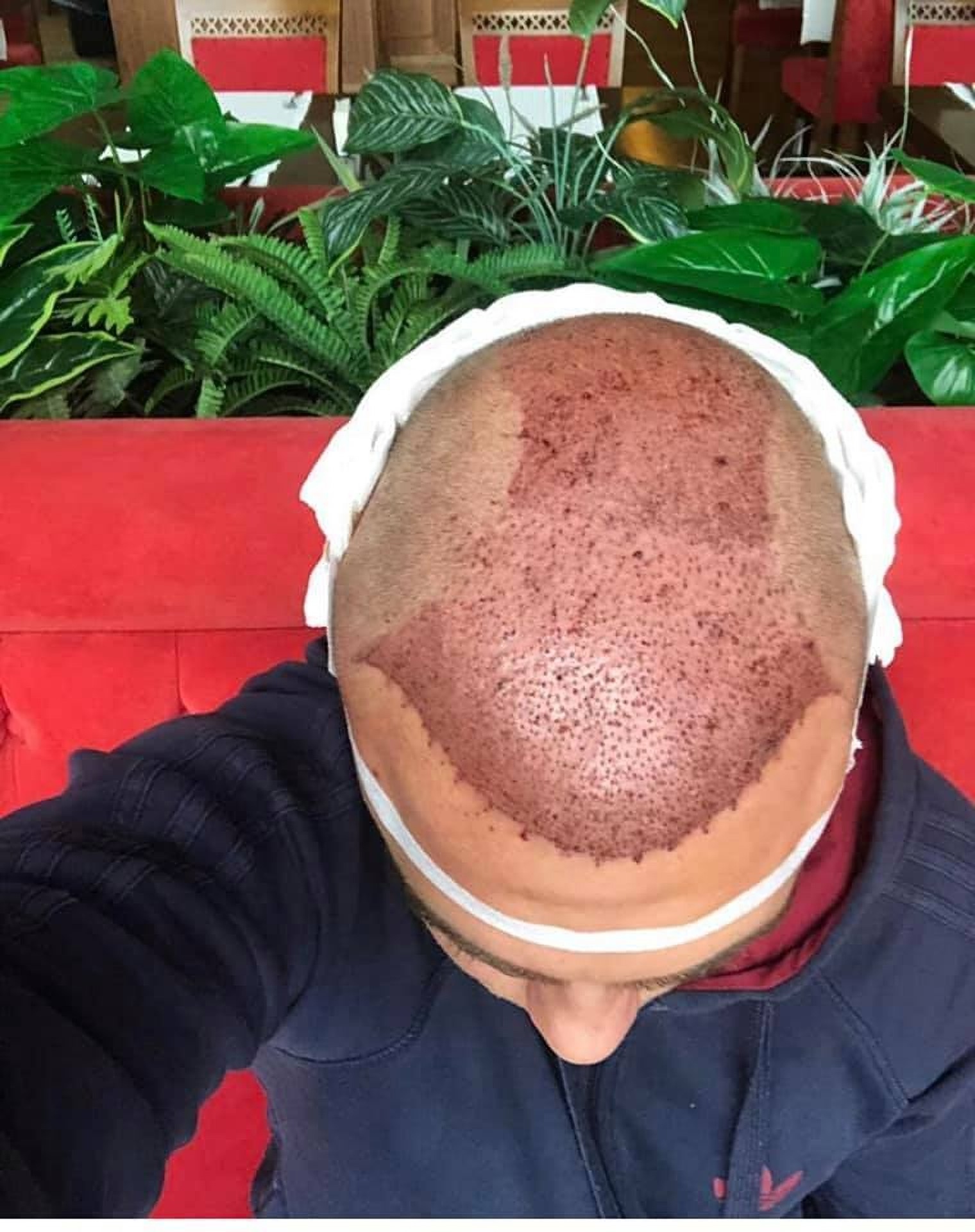 Пересадка волос FUE в Стамбуле в клинике Estethica