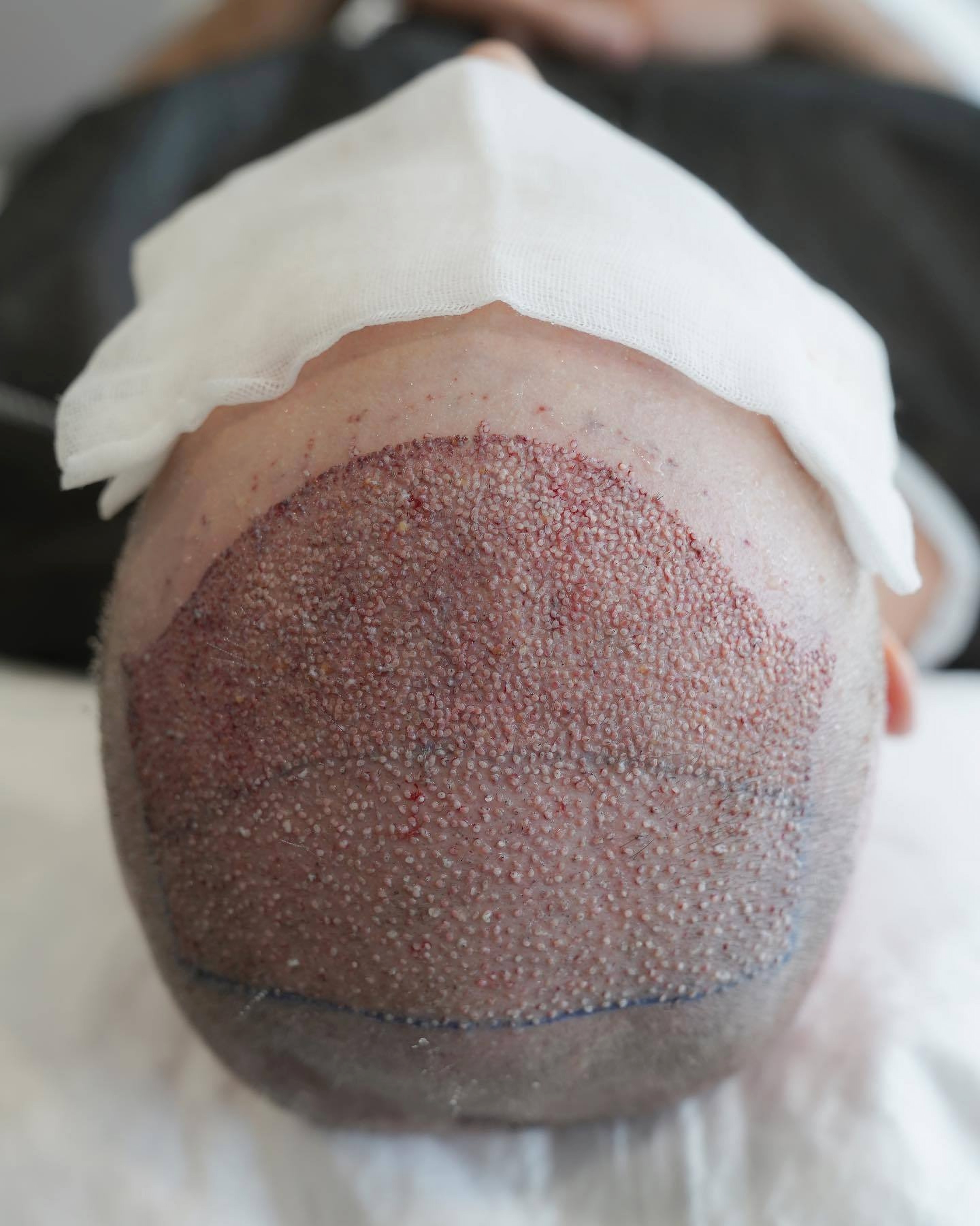 Кожа головы после пересадки волос в Турции