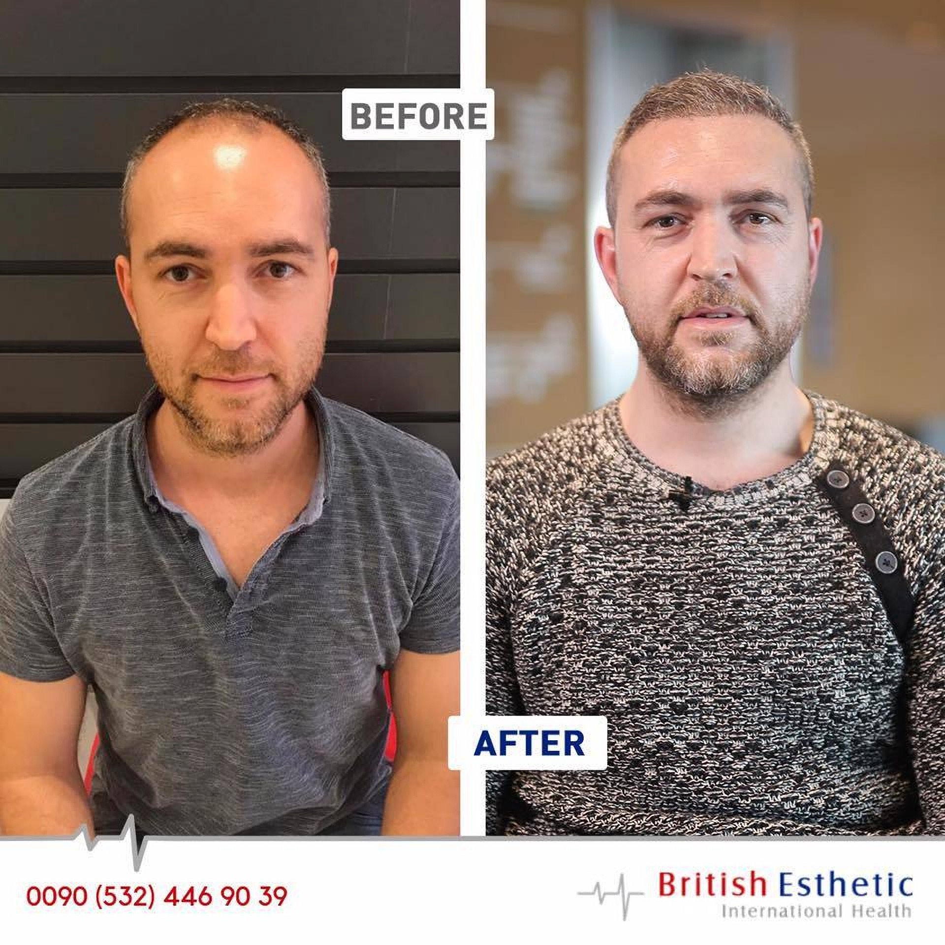 Трансплантация волос в клинике British Estetik в Стамбуле