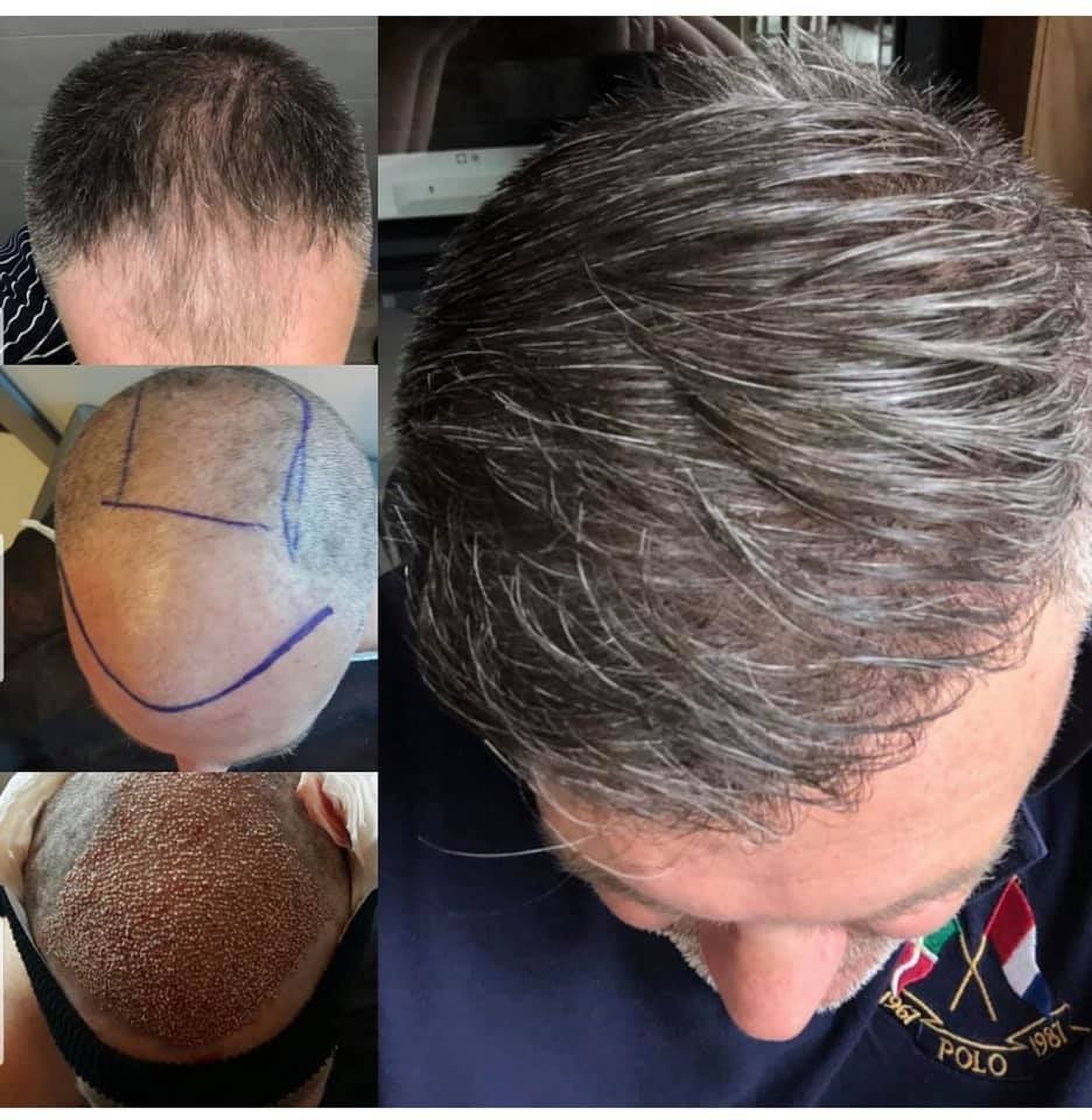 Результаты пересадки волос в Стамбуле в клинике Estethica