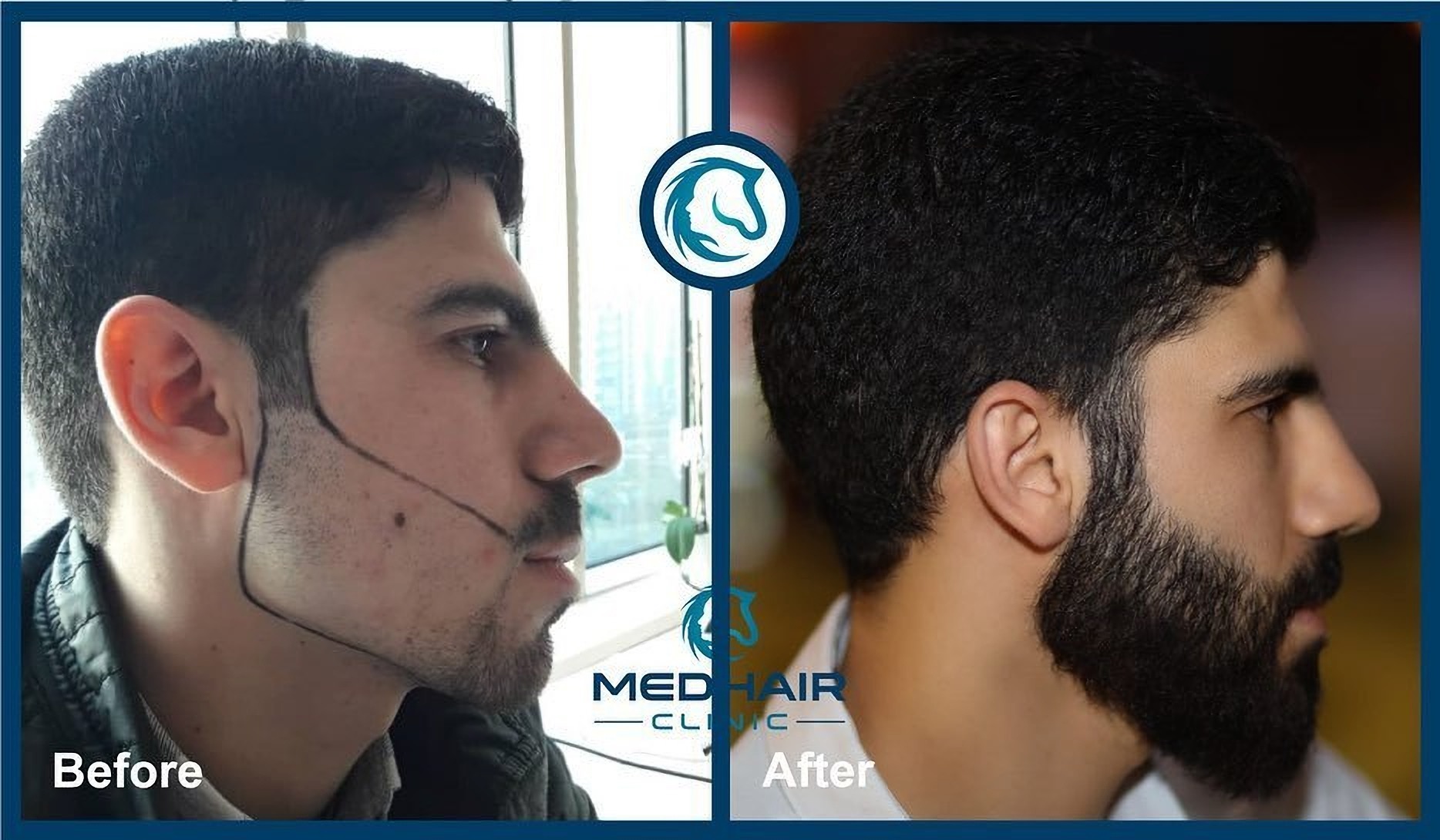 Пересадка волос для бороды в Турции