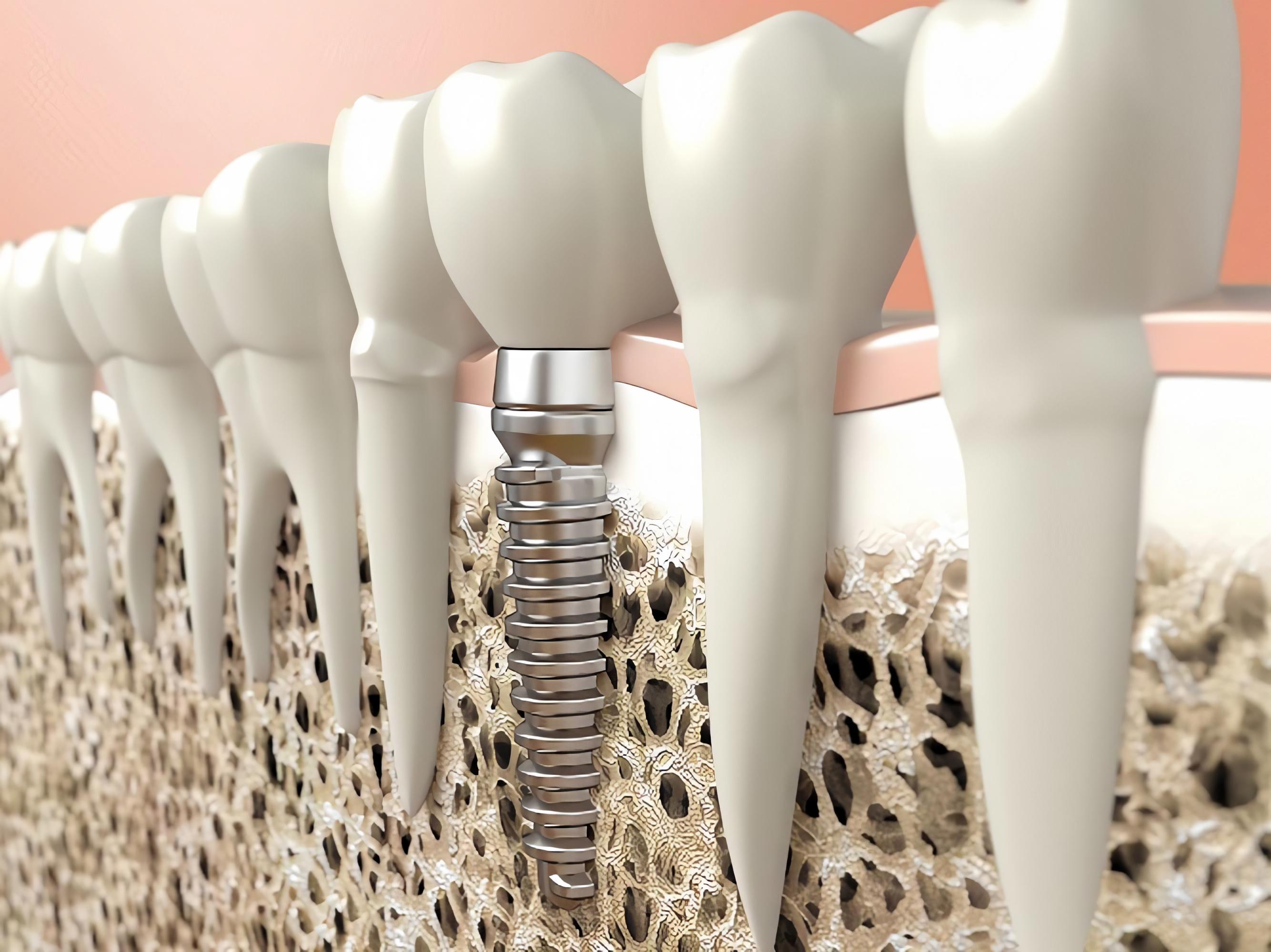 Можно ли имплантировать зубы при остеопорозе